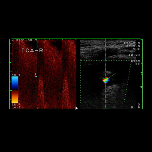 Ultraschallbild einer Einengung (Stenose) einer der 4 Halsschlagadern (A. carotis interna) mit erhöhtem Blutfluss in der Engstelle