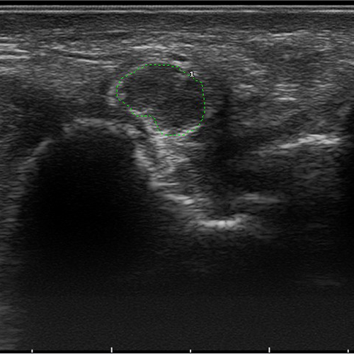 Ultraschallbild eines geschwollenen Nerven bei Einklemmung (N. ulnaris beim Sulcus ulnaris Syndrom)