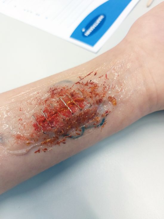 Aus Vaseline, Mehl und Lebensmittelfarbe entstanden verschiedene realistische Wunden wie hier mit Klammerverschluss. (Foto: AGUS Akademie/Denise Schönberg).